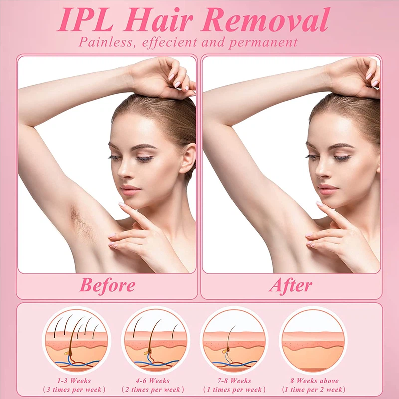 IPL Laser Epilator 1 IPL Laser Epilator 1